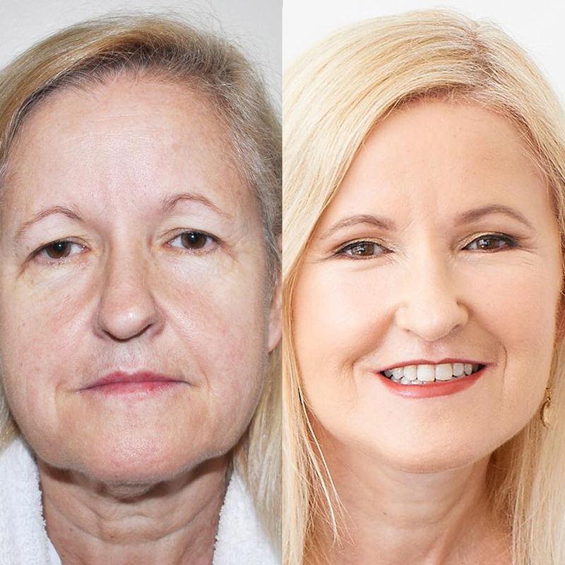 Dr Zacharia performed an upper and lower blepharoplasty (eyelids), a brow lift and a deep plane face and neck lift.