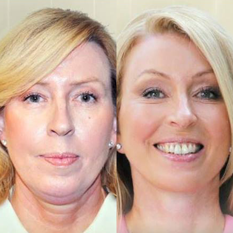 Facelift and Necklift Surgery